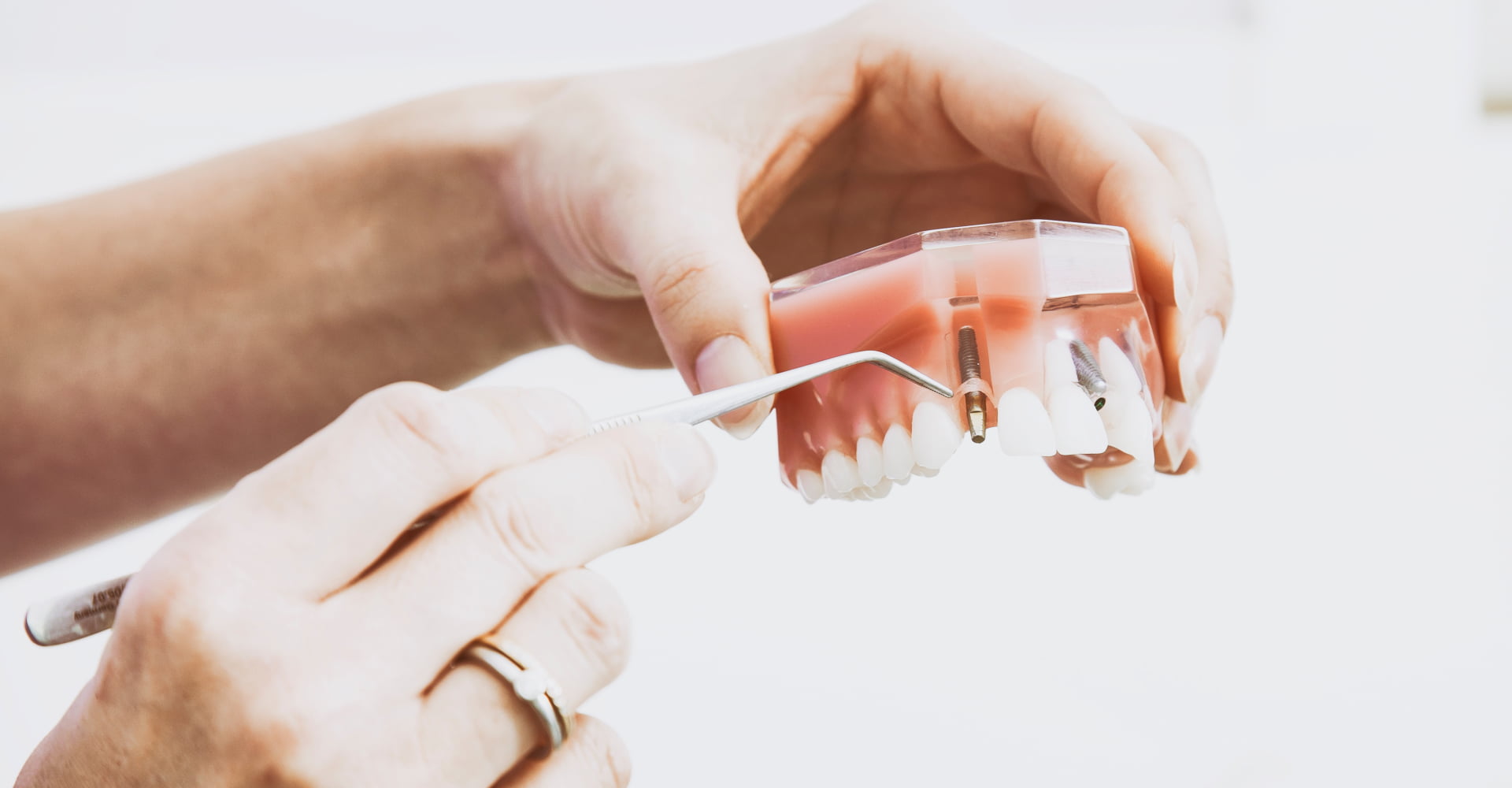 Костная пластика при имплантации зубов: советы стоматолога