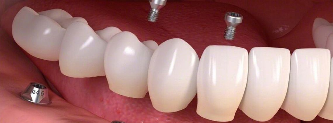 Какие есть виды зубных имплантов?