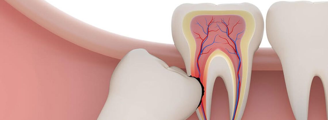 Нужно ли удалять зубы мудрости?