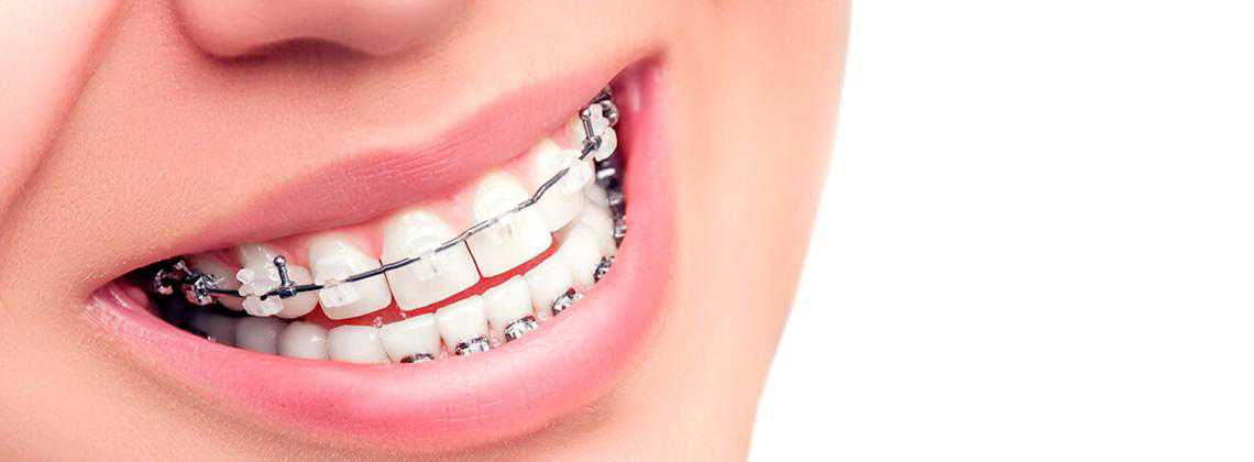 Брекет-система у Дніпрі