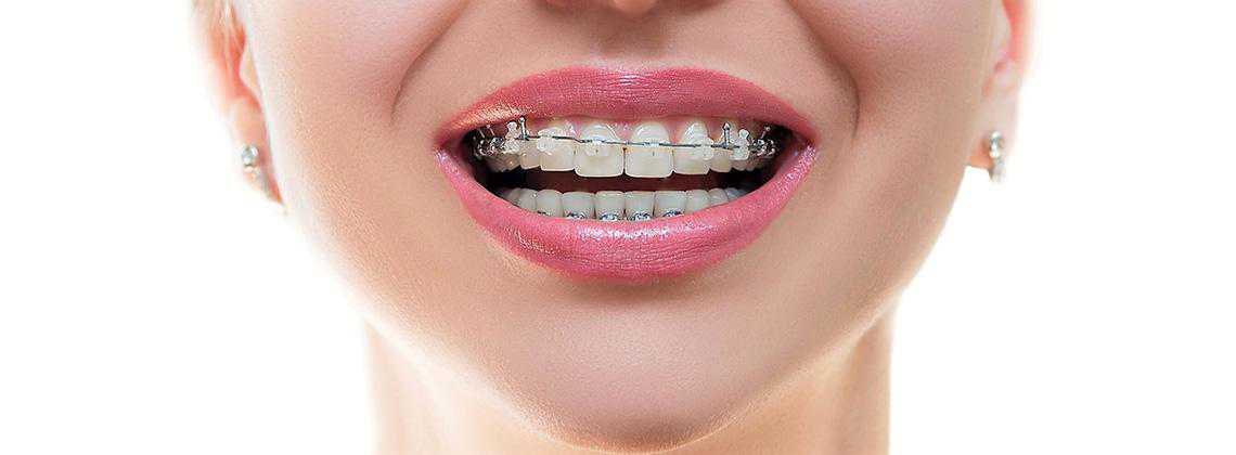 Ортодонтія – вікові обмеження