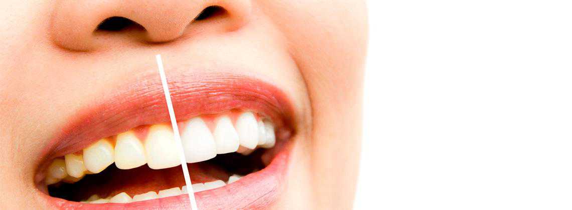 Плюси та мінуси відбілювання зубів у домашніх умовах