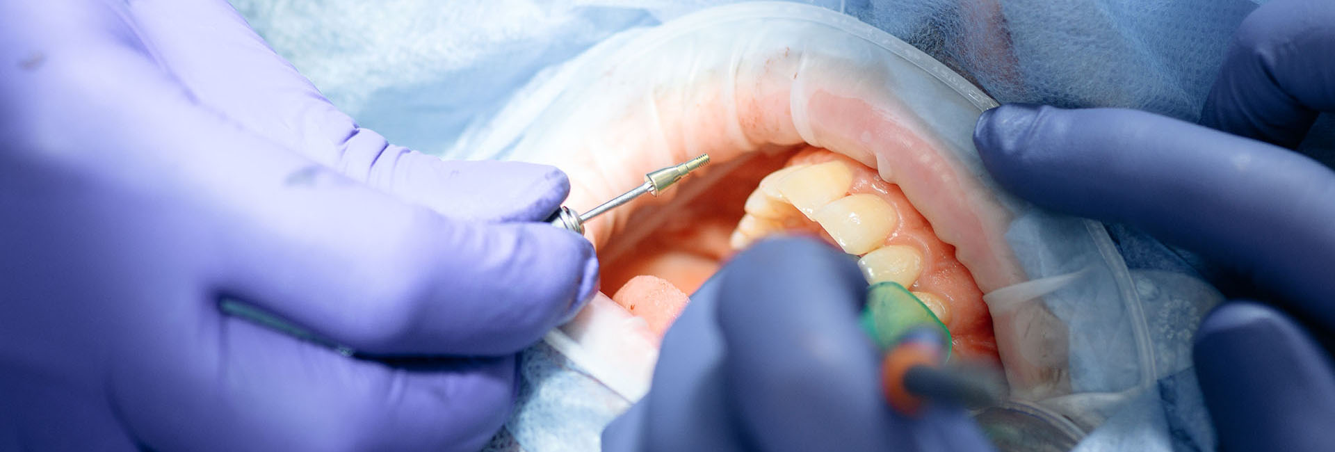 Імплантологія